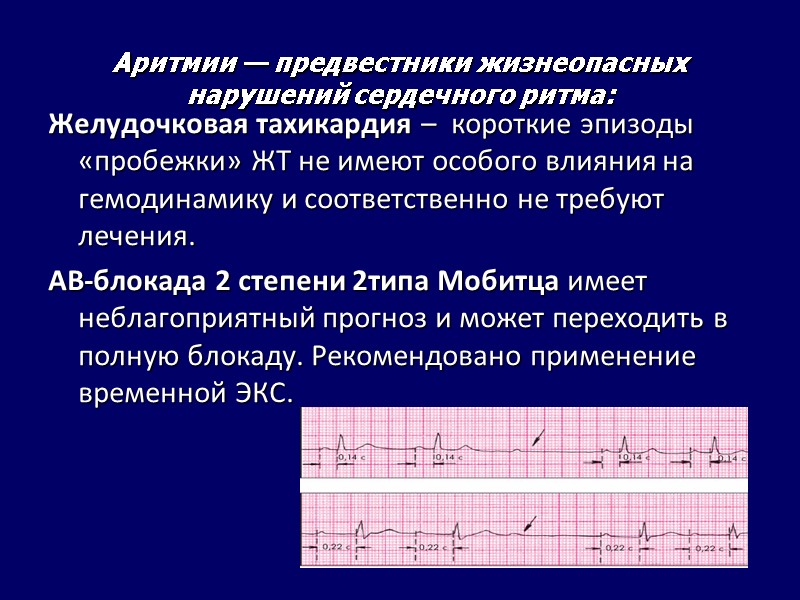 Аритмии — предвестники жизнеопасных нарушений сердечного ритма: Желудочковая тахикардия – короткие Аритмии — предвестники жизнеопасных нарушений сердечного ритма: Желудочковая тахикардия – короткие